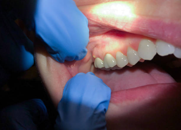 Best Urgent Care for Lost Fillings or Crowns in Lake City, FL